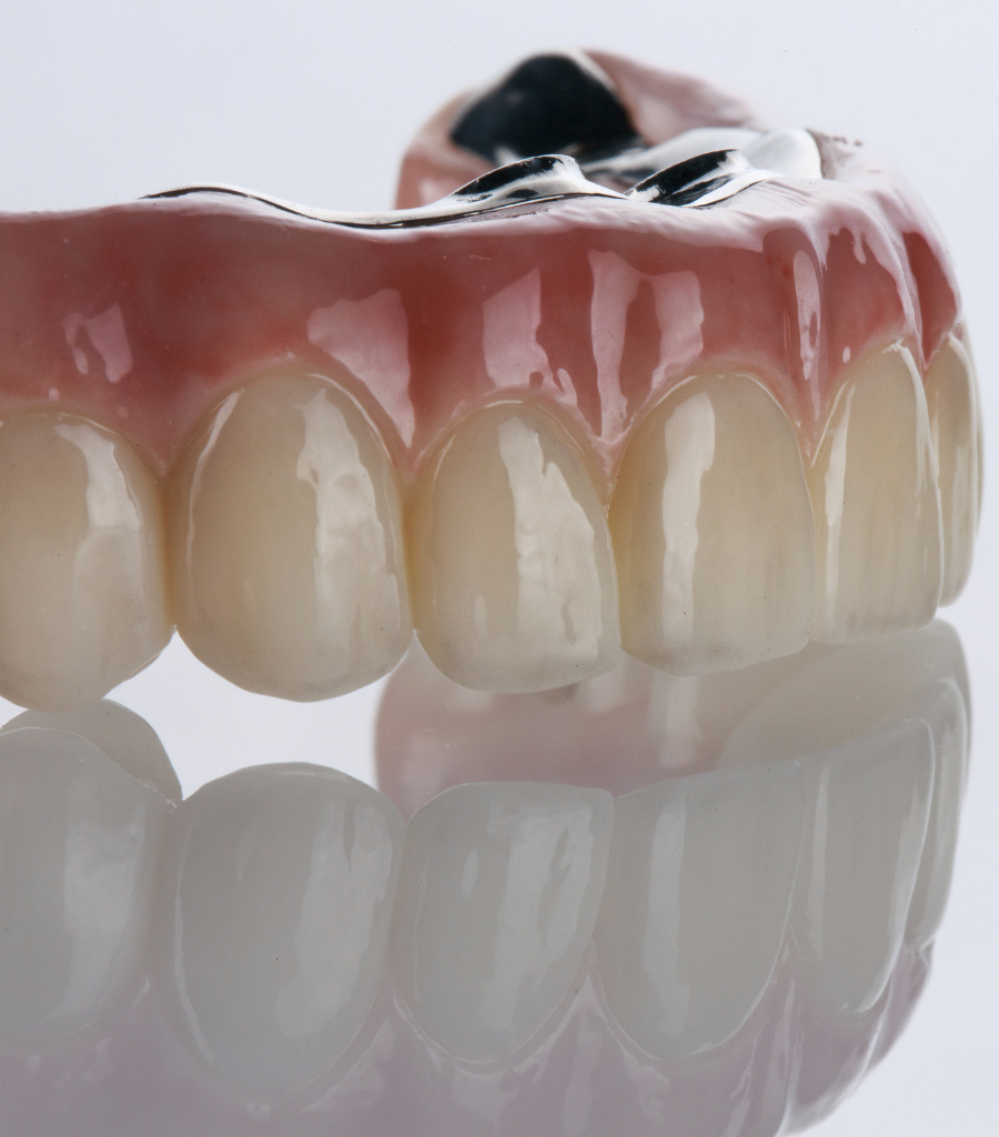 Zirconia All-on-X Dental Implants with Titanium Bar at Renuix Dental Lab