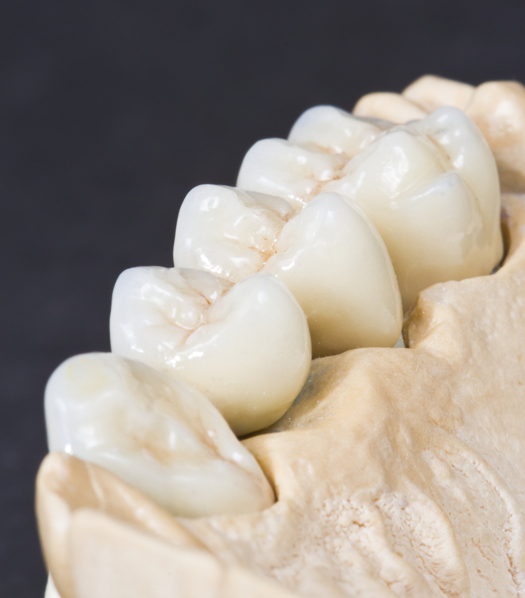 Custom crown and bridge restorative solutions at Reniux Dental Lab