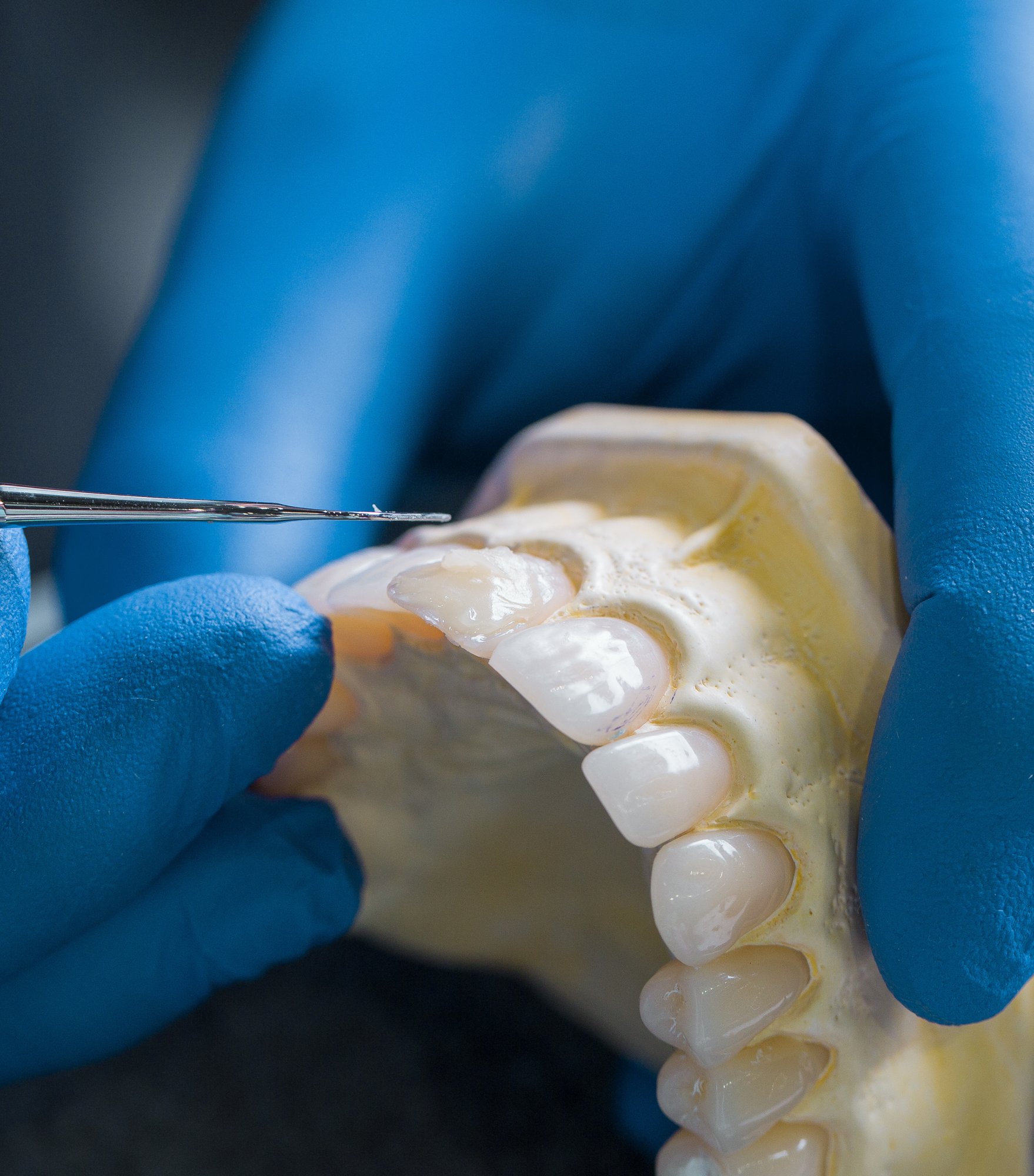 Lithium disilicate crown at Reniux Dental Lab