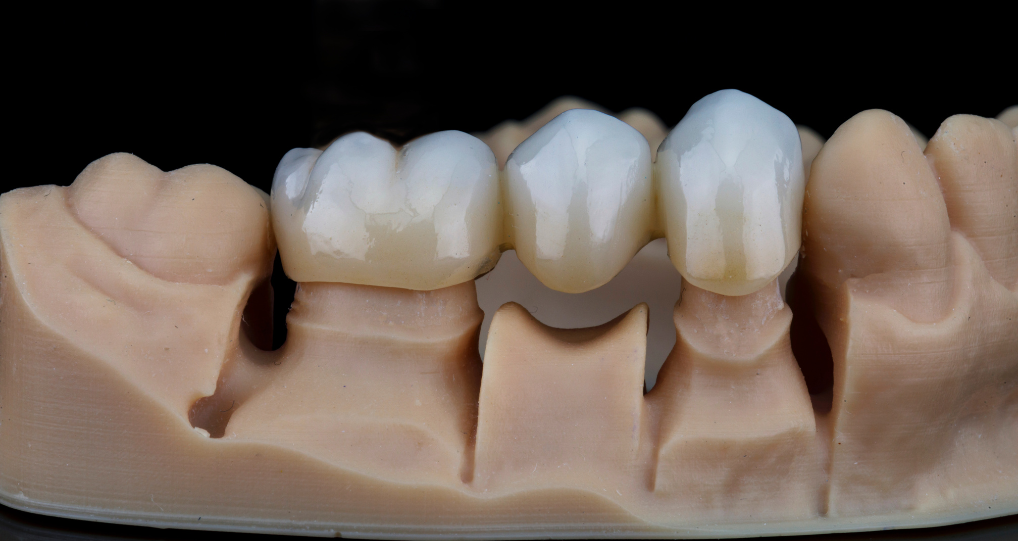 Crown and bridges at Renuix Dental Lab