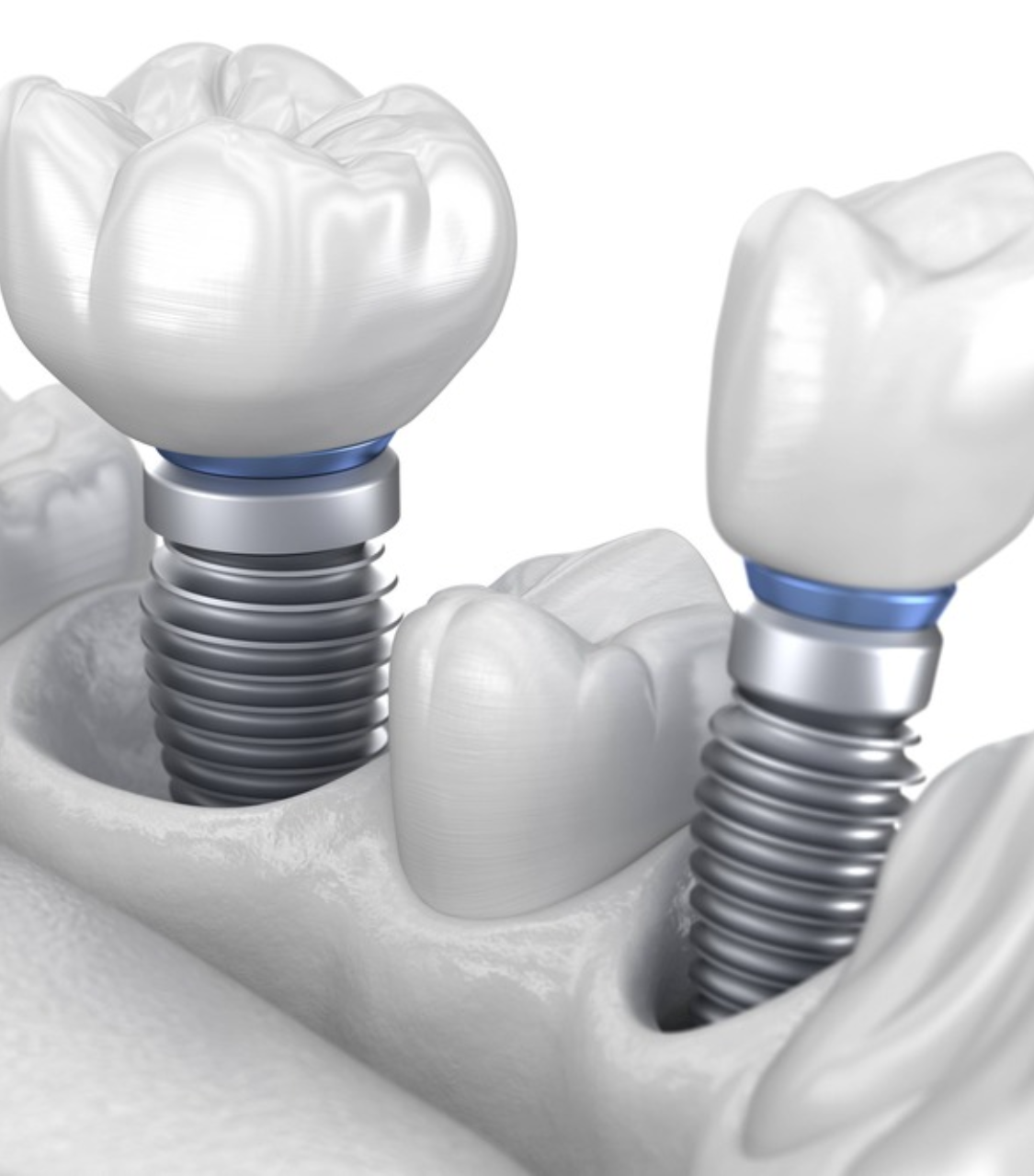 Titanium-Base Restorations at Reniux Dental Lab